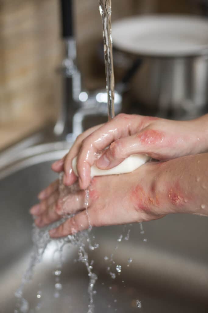 skin irritation from hard water